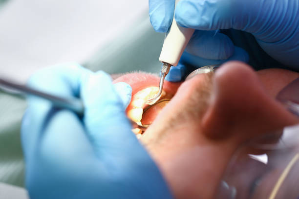 Best Emergency Wisdom Teeth Removal in Gretna, VA